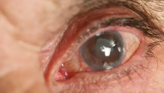 "Katarakt ameliyatı" deyip geçmişti: Adeta hayatı karardı