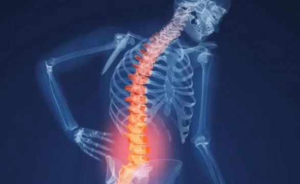 Atmosferdeki karbondioksit artı: İklim krizi kemiklerimizi eritiyor