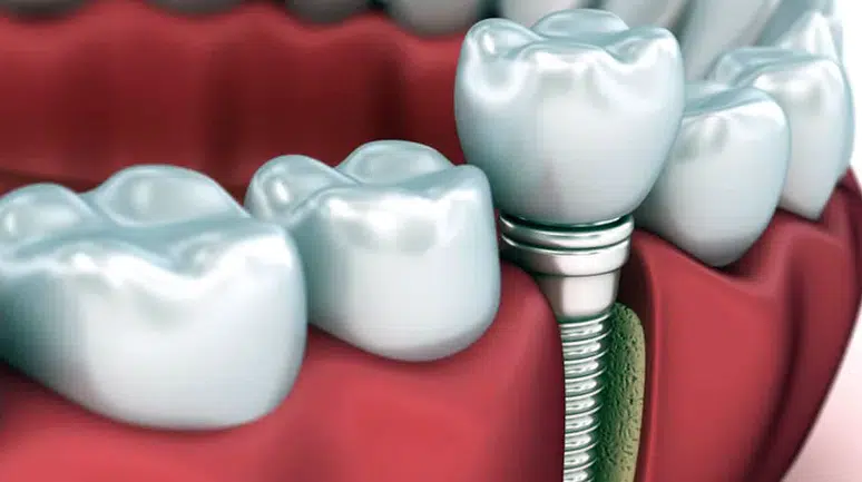 Nasıl anlaşılır: Vatandaşa kaçak ve sahte implant takılıyor