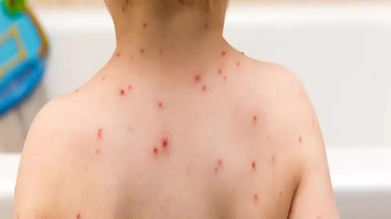 Okullarda suçiçeği salgını: İdare çaresiz veliler tedirgin