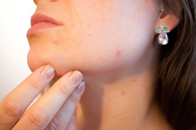 acne-1606765-640.jpg