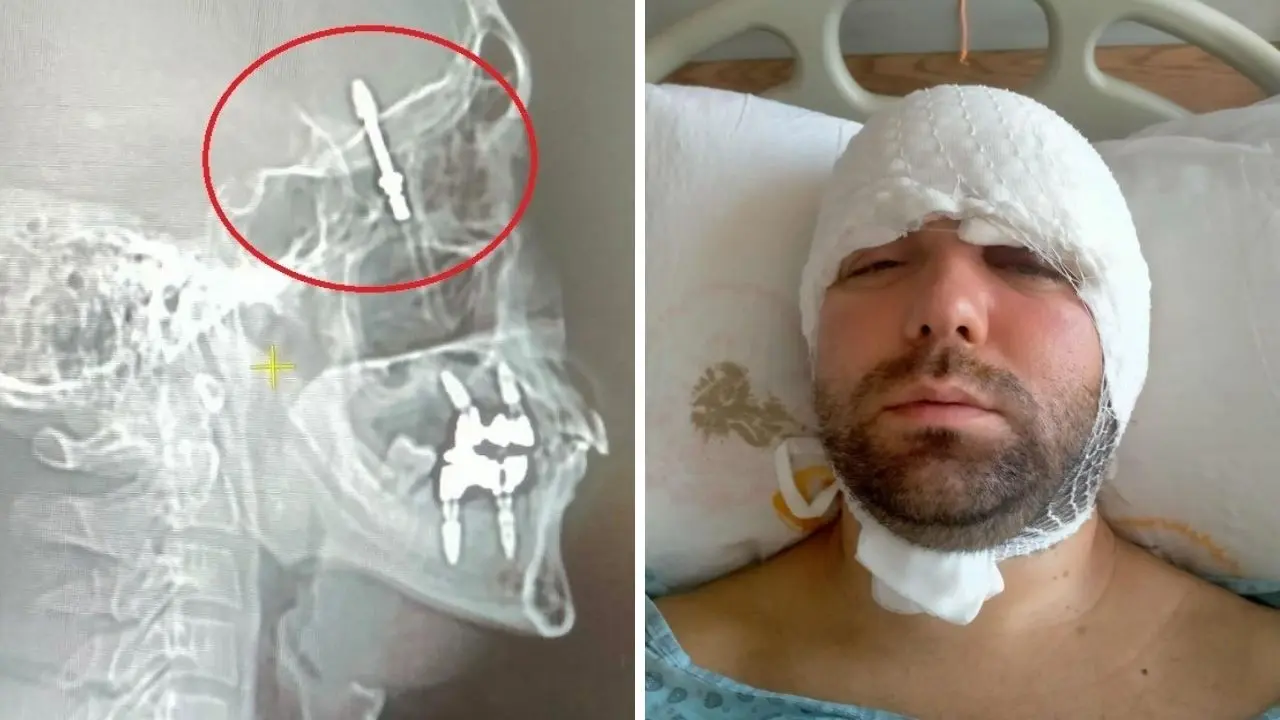 Beynine saplanan implant hayatını kabusa çevirdi! Diş hekimine verilen cezaya isyan etti - 1. Resim