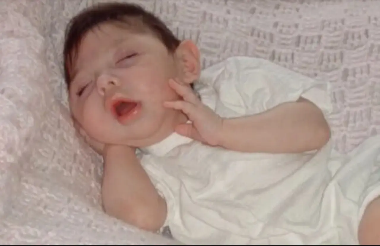 Beyni olmadan dünyaya gelmişti: Doktorlar 5 yıl bile yaşamaz dedi, şimdi 20 yaşında - 2. Resim