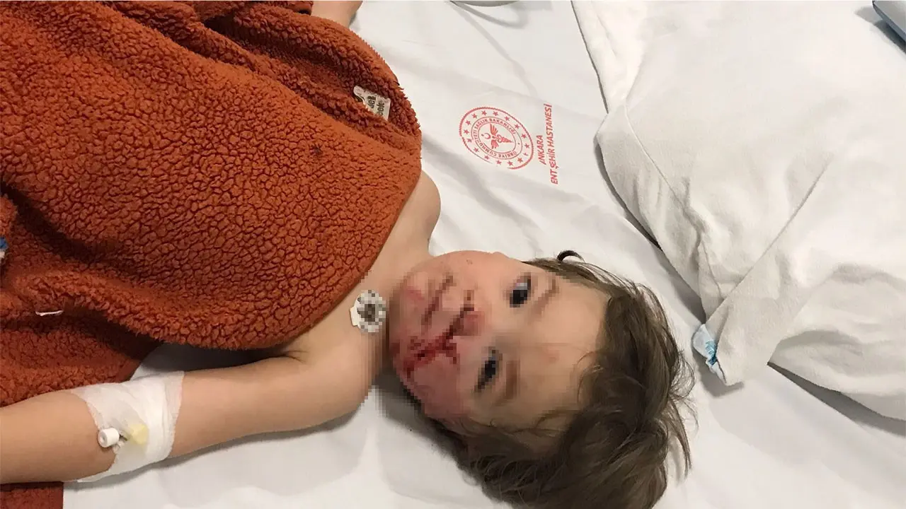 Ankara’da 1,5 ve 5 yaşındaki kardeşler pitbull saldırısına uğradı