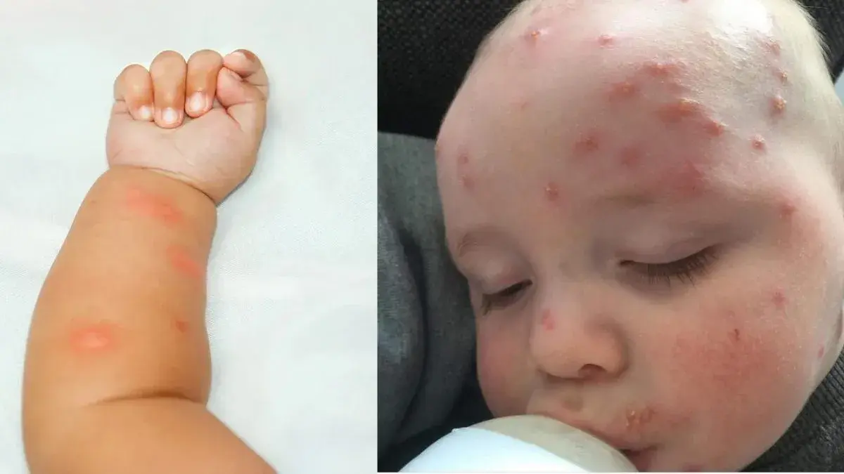 Are Babies Immune to Mosquito Bites? What's the Best Way to Treat Them? |  OnlyMyHealth