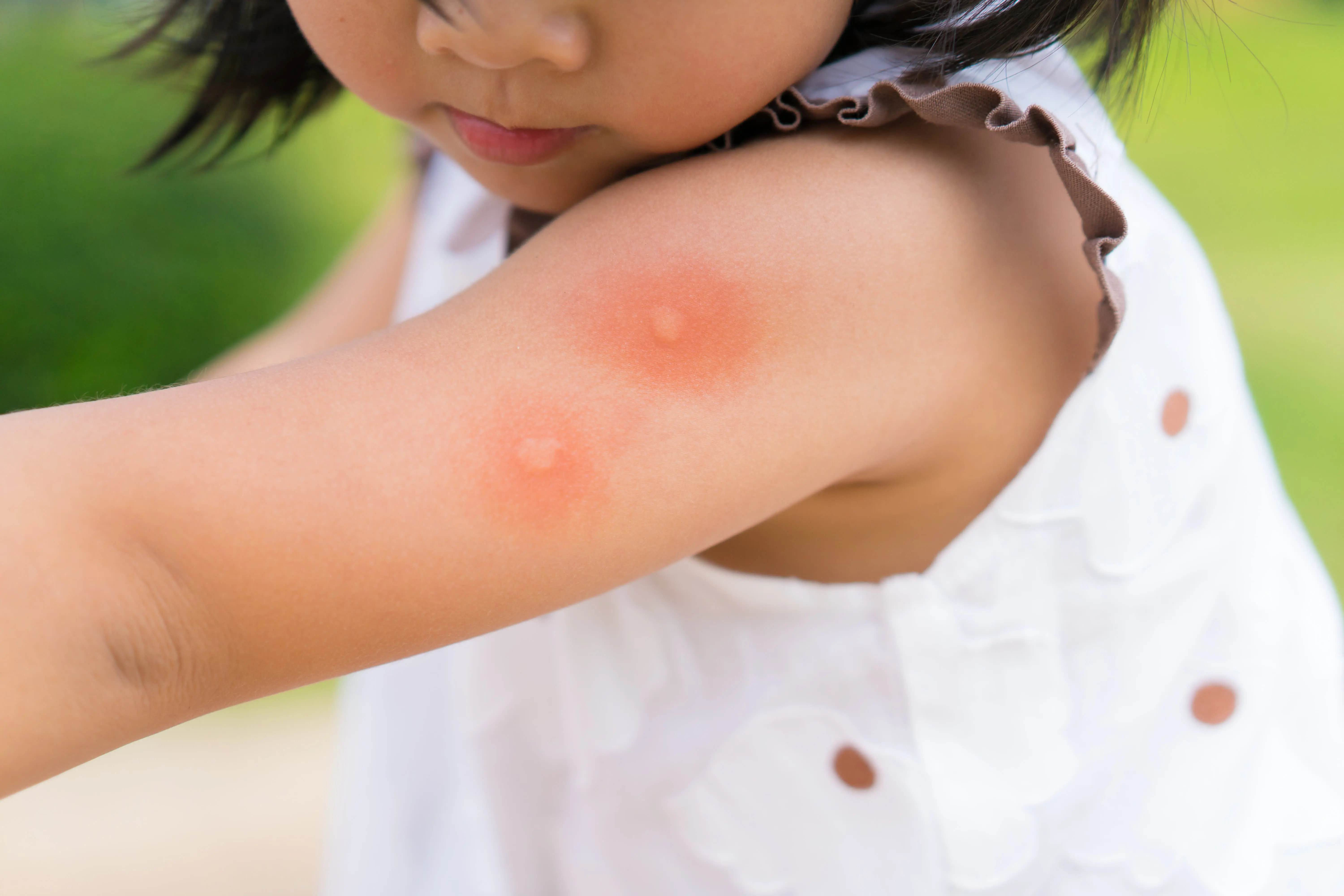Mosquito Bite Relief: The Diaper Balm (Yes!) That Stops the Itching | Cubby