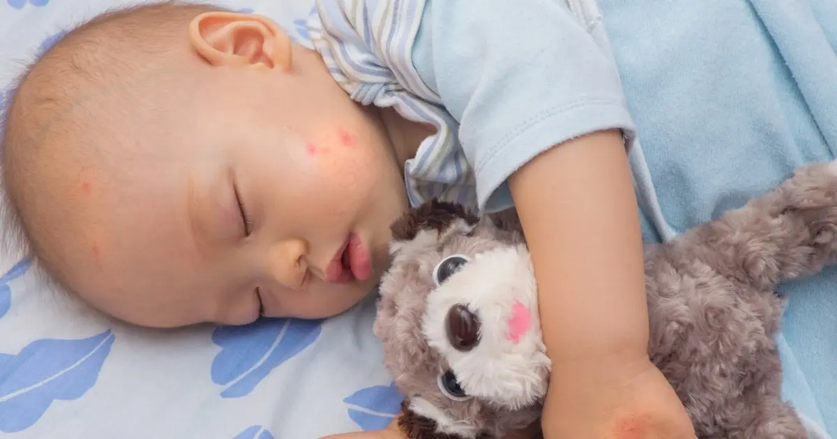 Bug Bites in Babies: Symptoms You Shouldn't Ignore
