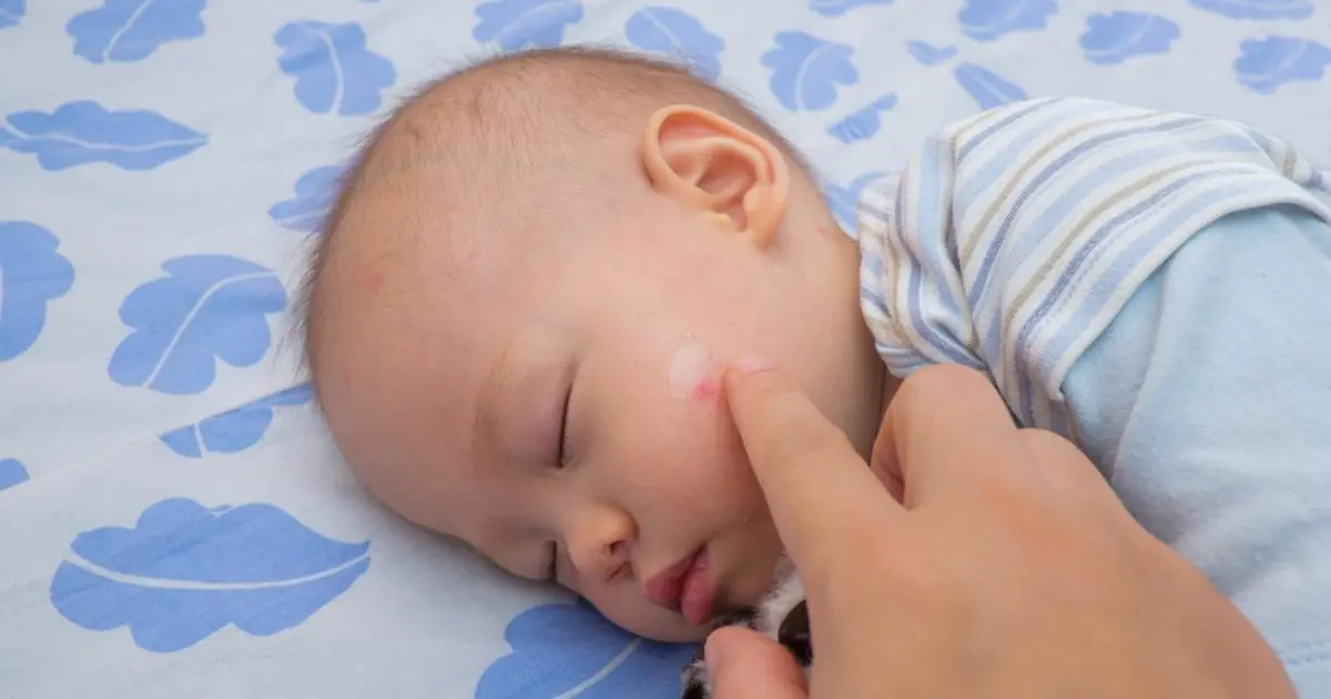 How to Treat Mosquito Bites in Babies and Prevent Mosquito Bites