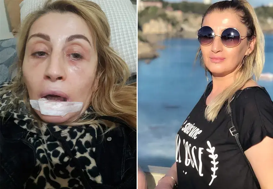 Dolgu yaptırdığı dudağı çürüdü. "Ana damarlarım çürümüş, gülüşüm yok, yemek yiyemiyorum" 1