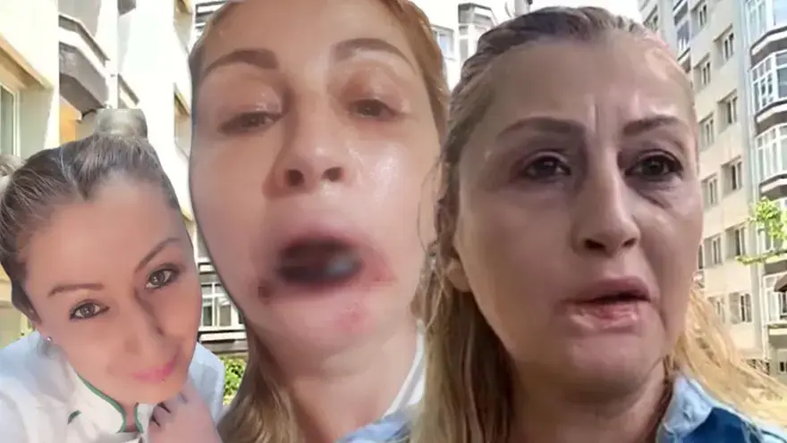 Dolgu yaptırdığı dudağı çürüdü. "Ana damarlarım çürümüş, gülüşüm yok, yemek yiyemiyorum" 