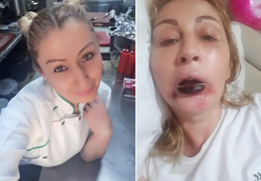 Dolgu yaptırdığı dudağı çürüdü. "Ana damarlarım çürümüş, gülüşüm yok, yemek yiyemiyorum" 2
