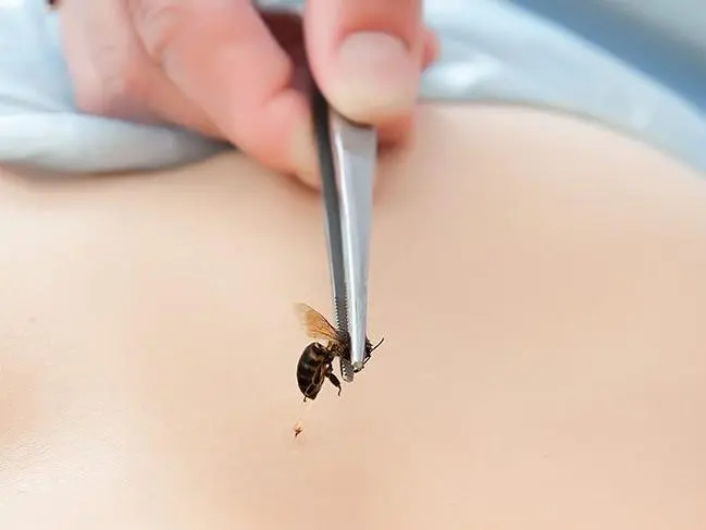 Arı sokması belirtileri neler? Arı sokması alerjisi nasıl anlaşılır? İşte  tedavi önerileri... - Sözcü