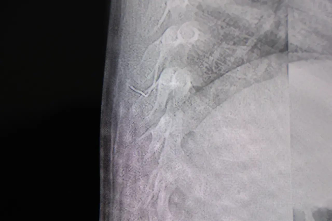 Böylesini ne gördük ne duyduk! 1 yaşındaki bebeğin sırtından zımba teli çıktı