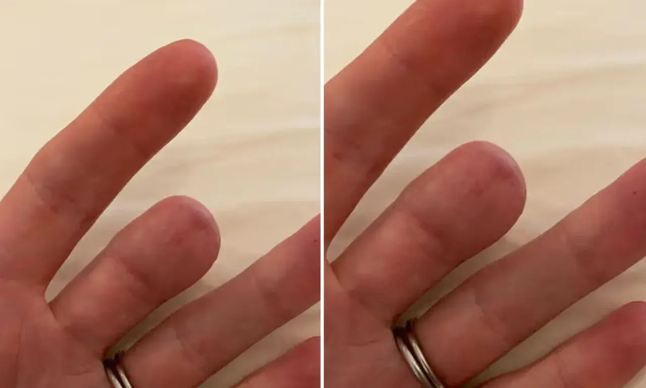 Başka hiçbir şikayeti yoktu… Tırnak altındaki çizgi ölümcül hastalığın işareti çıktı!